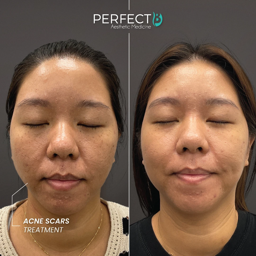 ACNE SCARS