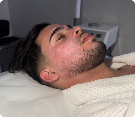 Patient with acne scars receiving treatment at Perfect B