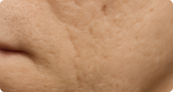 Ice Pick Scars