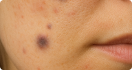 Pigmented Marks