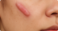 Keloid Scars