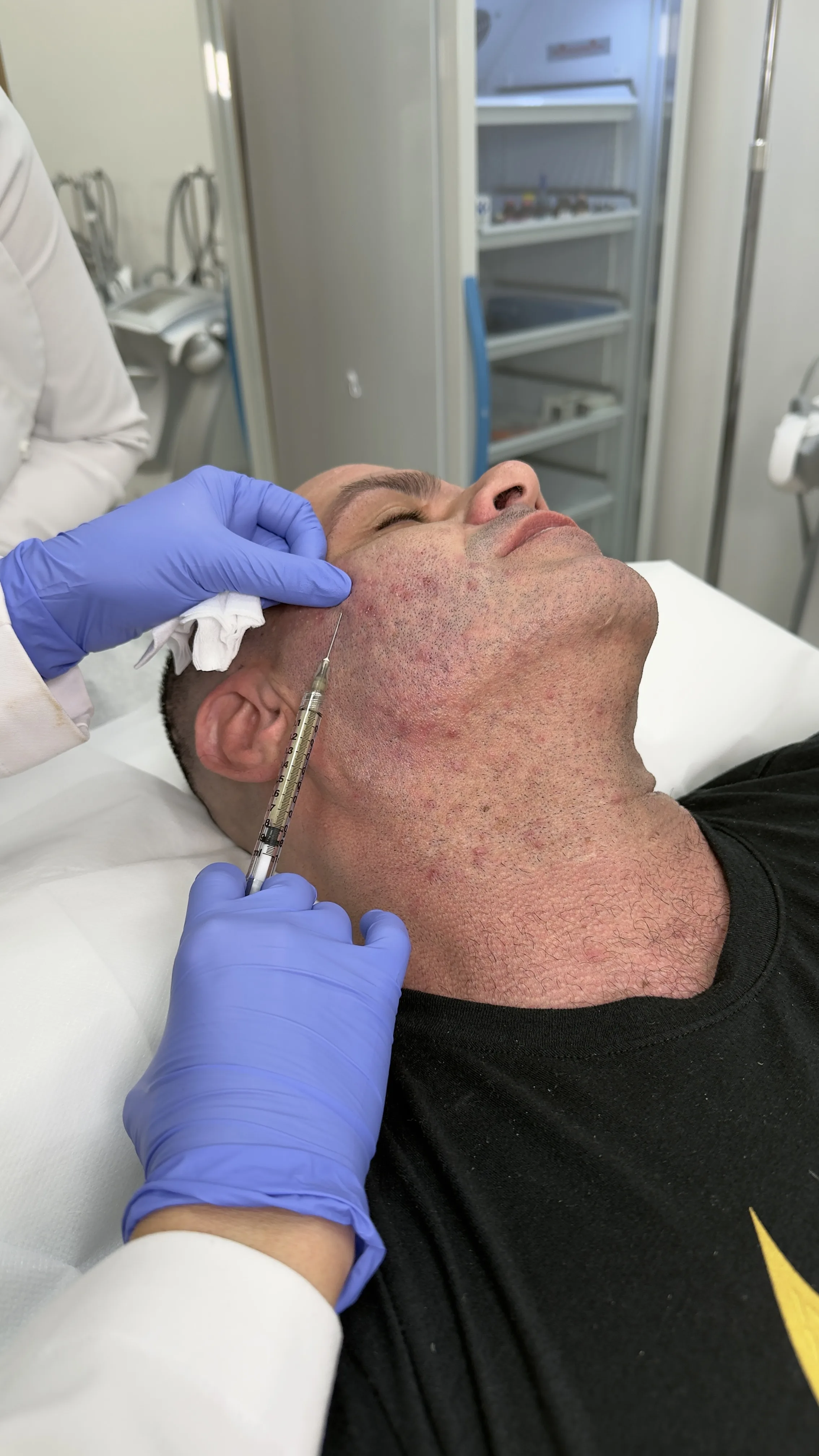 Acne Scars Treatment at Perfect B