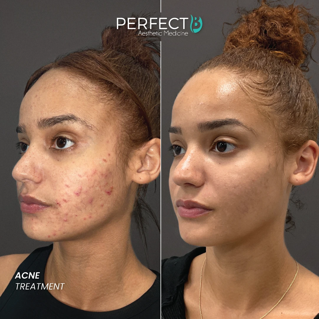 ACNE TREATMENT