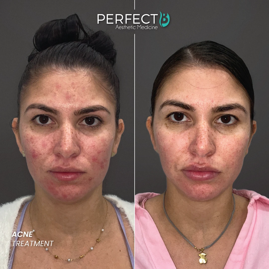 ACNE TREATMENT