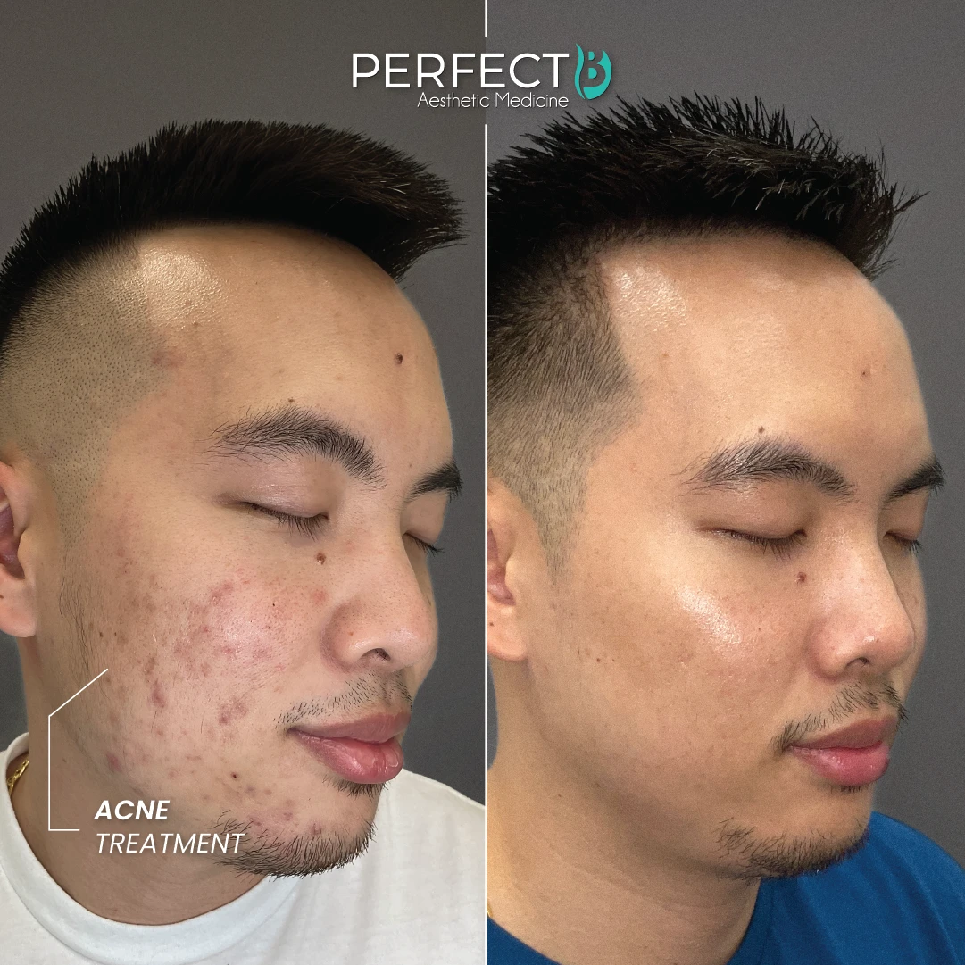 ACNE TREATMENT