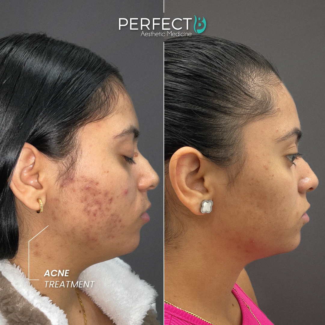 ACNE TREATMENT