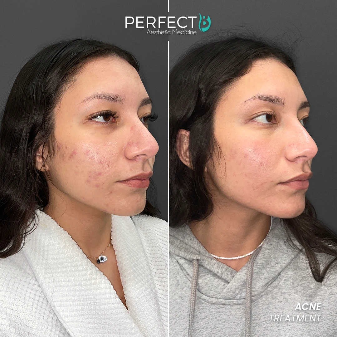 ACNE TREATMENT