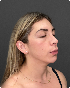 Acne treatment result 4
