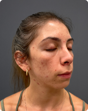 Acne treatment result 2
