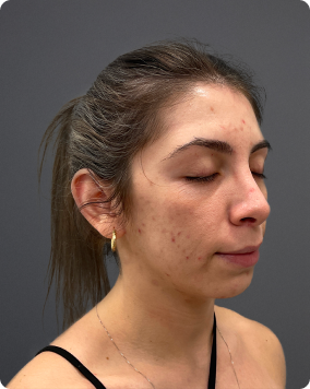 Acne treatment result 3