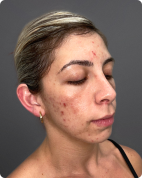 Acne treatment result 1