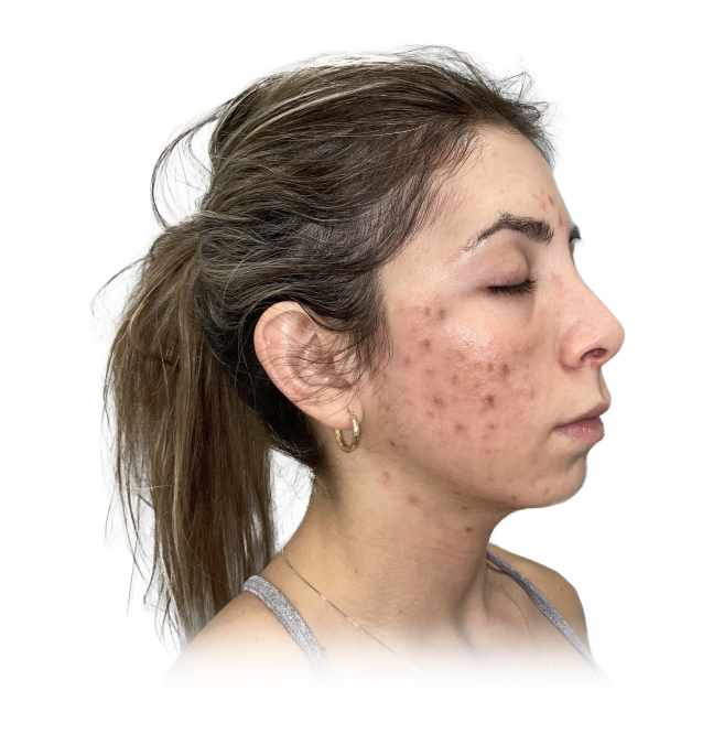 Patient before acne treatment - side profile
