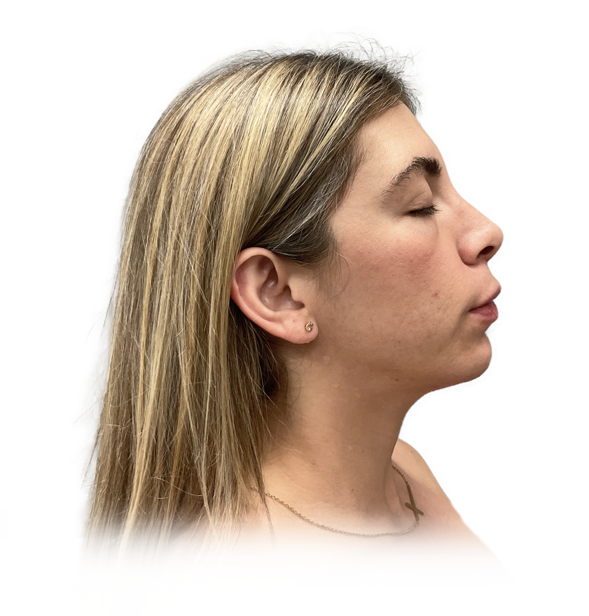 After acne treatment - clear skin result
