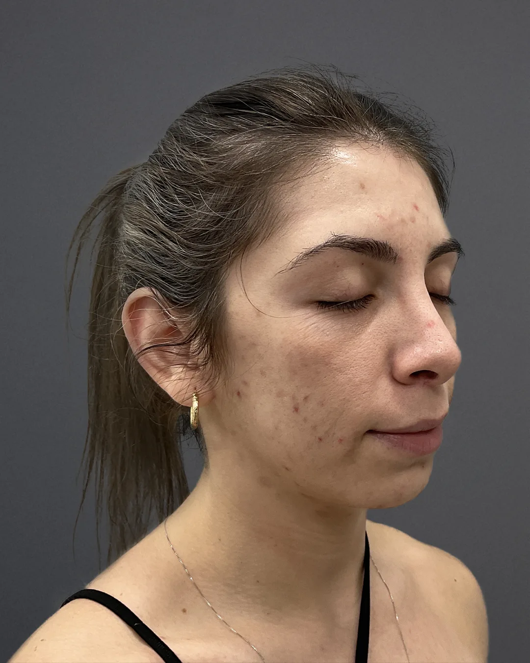ACNE SCAR