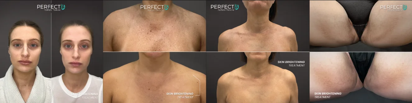 Skin brightening before and after results at Perfect B