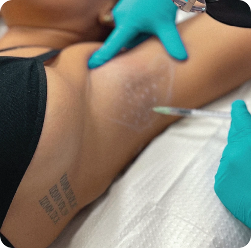 Botox hyperhidrosis injection at Perfect B
