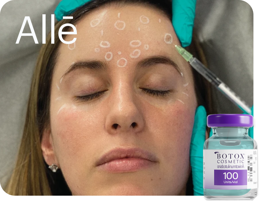 Forehead Botox injection at Perfect B