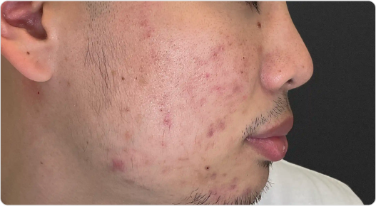 Acne Marks