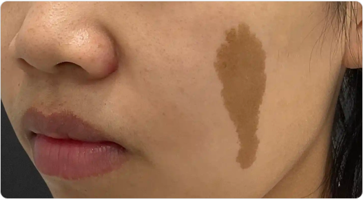 Birthmarks & Scars