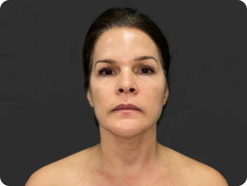 After skin rejuvenation treatment