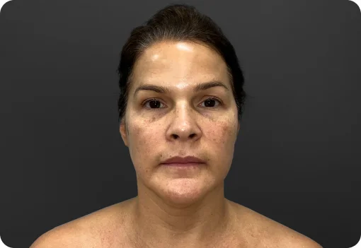 Before skin rejuvenation treatment