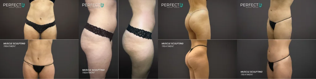 Real skin rejuvenation patient results at Perfect B