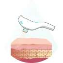 Lasers