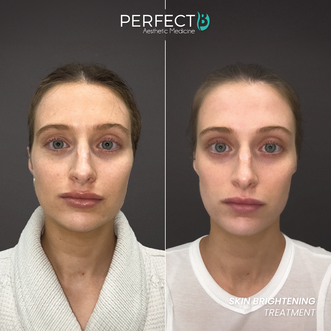 Perfect B result case 2