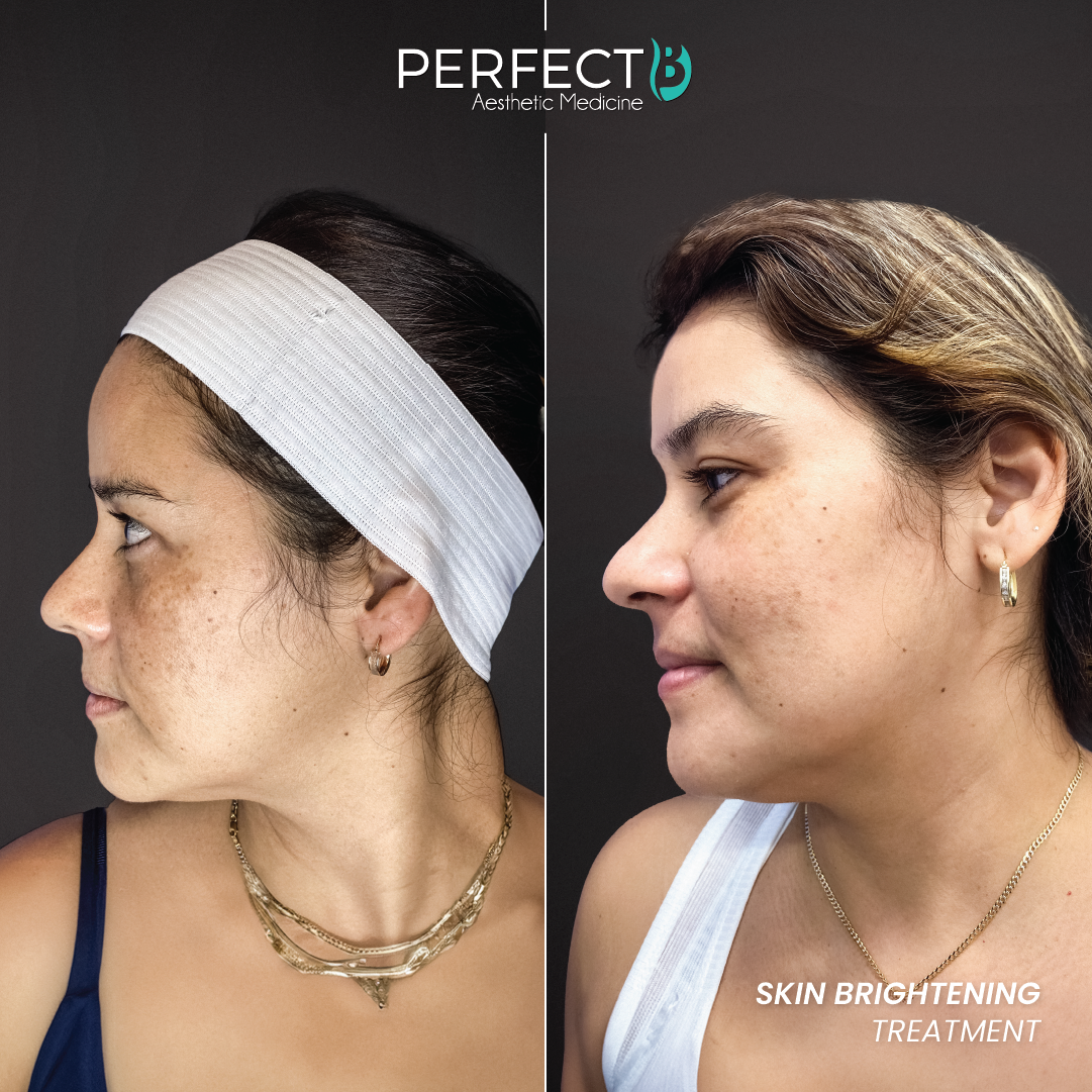 Perfect B result case 4
