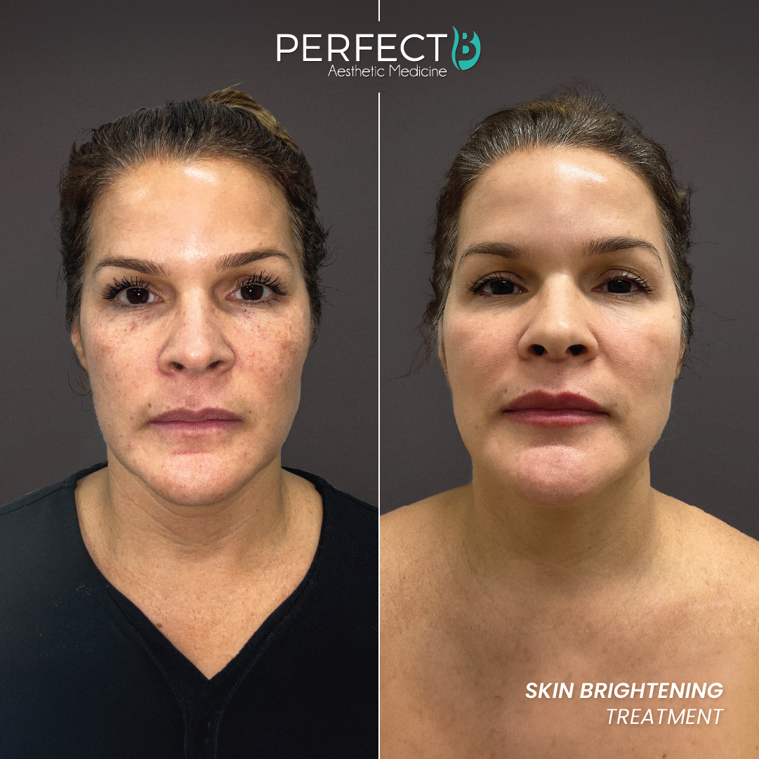 Perfect B result case 6
