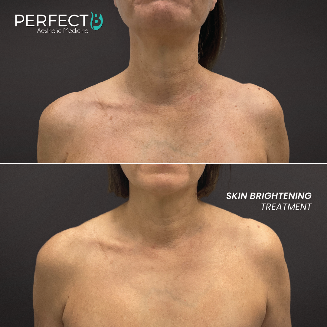 Perfect B result case 7