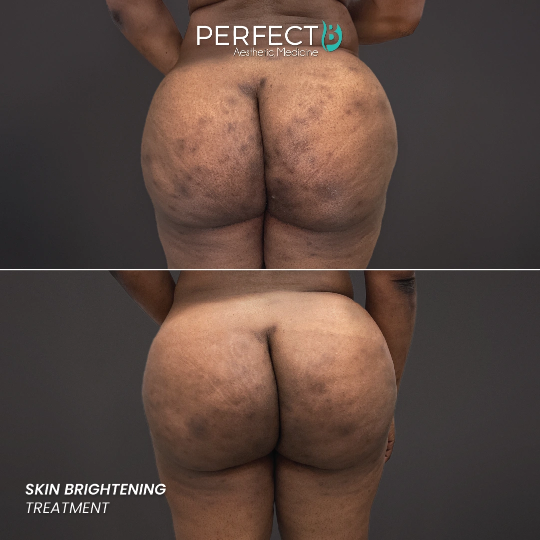 Perfect B result case 8