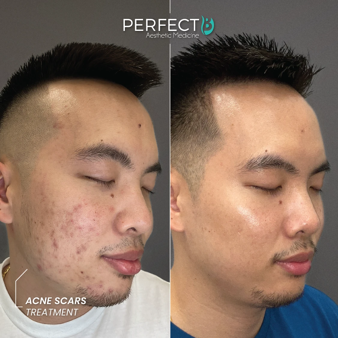 Acne Treatment - Perfect B - Results Image - Case 4005 - 1080 x 1080