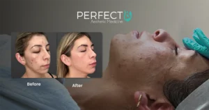 Perfect B - Acne Treatment - Portrait