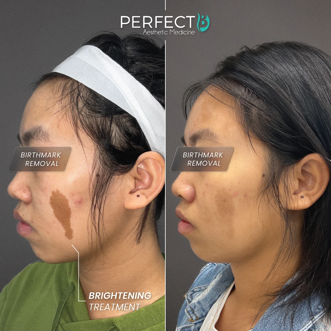 Brightening Treatment (Lesion Removal) - Perfect B - Results Image - Case 4505 - 1080 x 1080