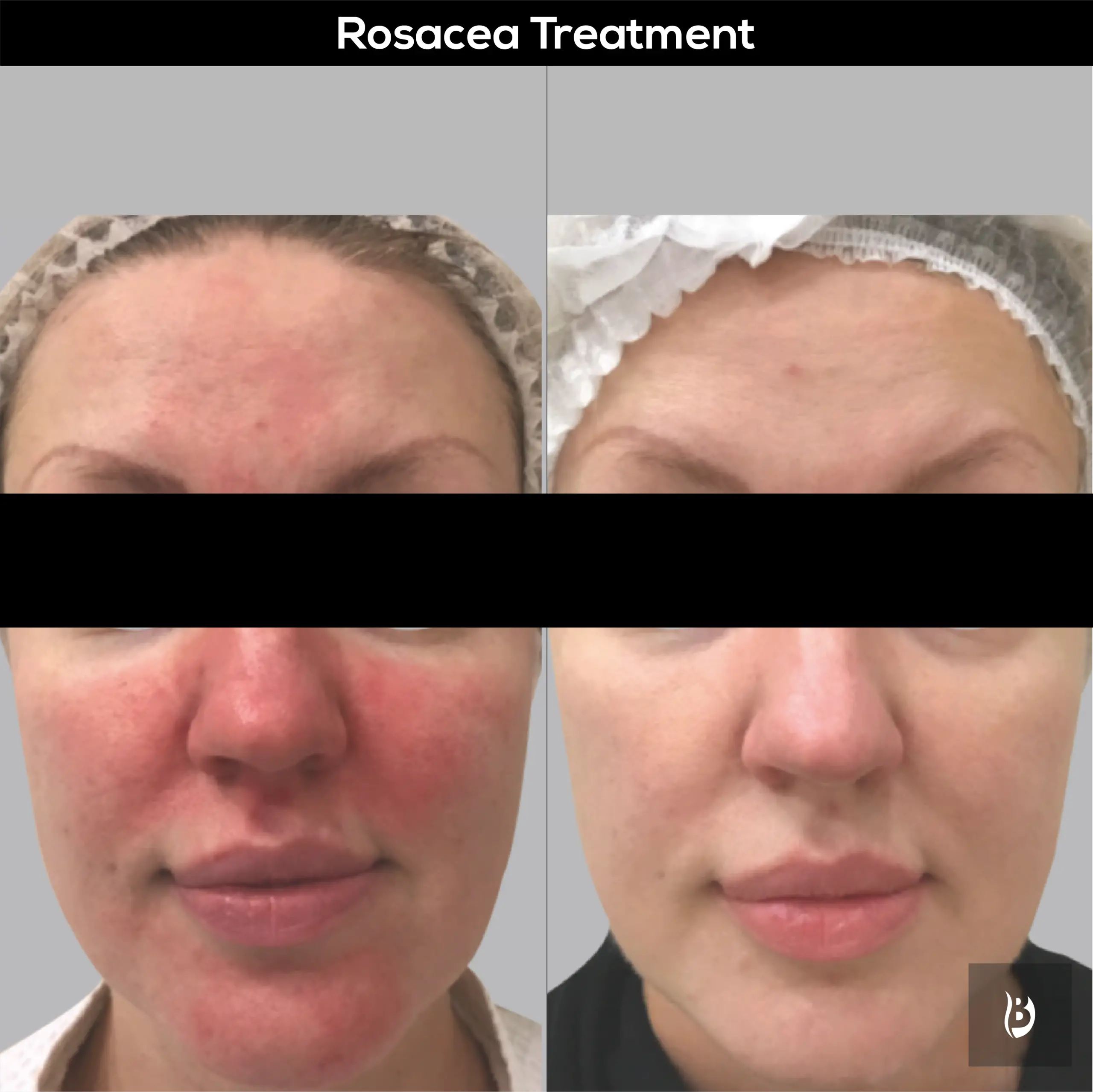 rosacea treatment