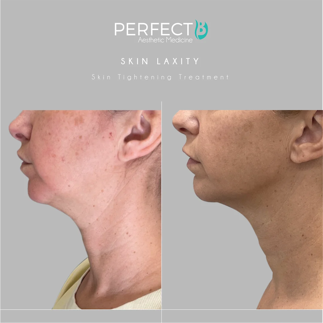 Skin Tightening Treatment Case 3345