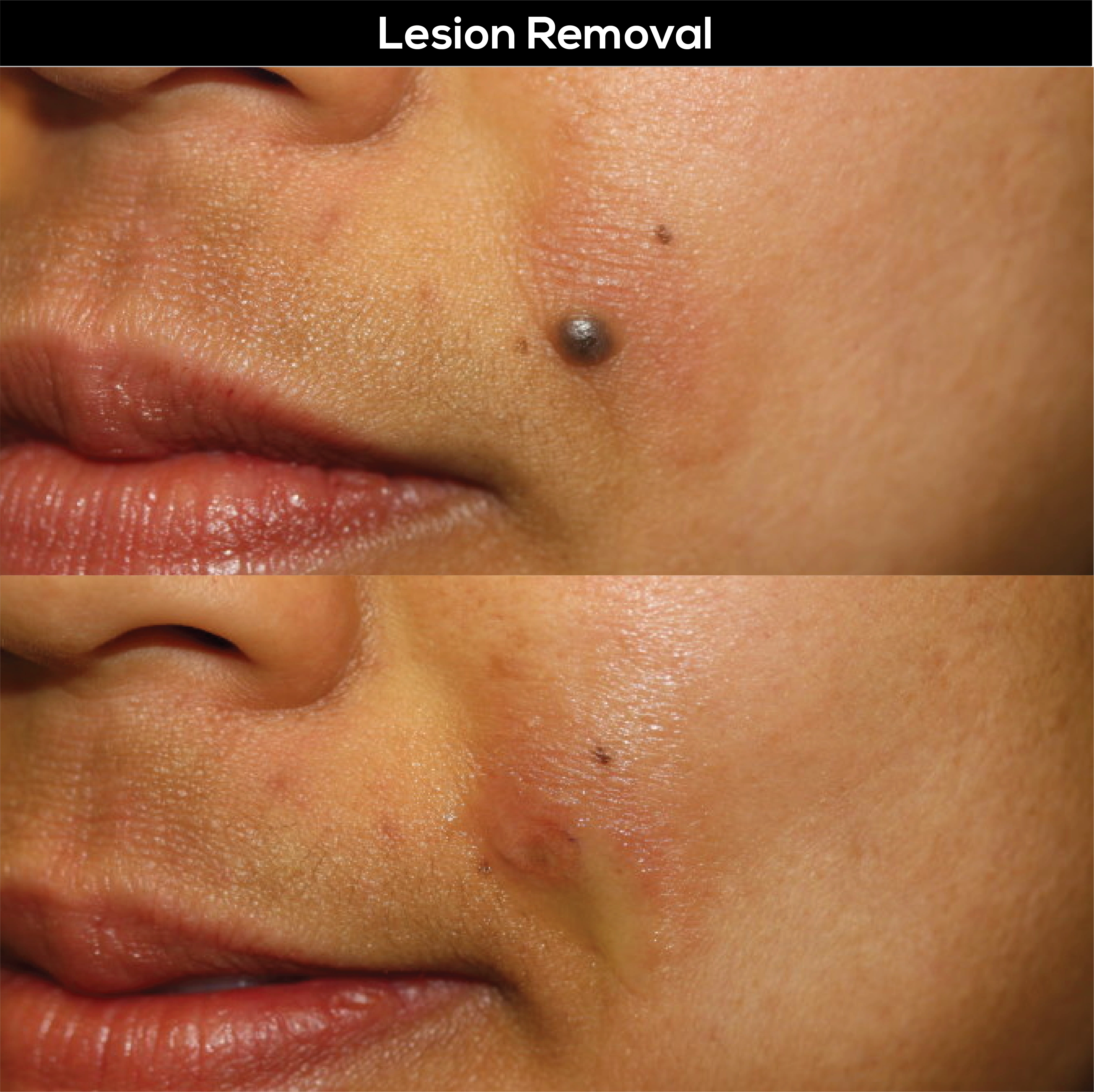 lesion removal