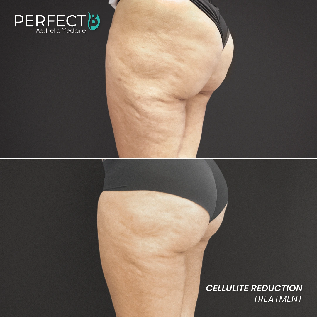Cellulite Reduction Treatment - Perfect B - Results Image - Case 4703 - 1080 x 1080