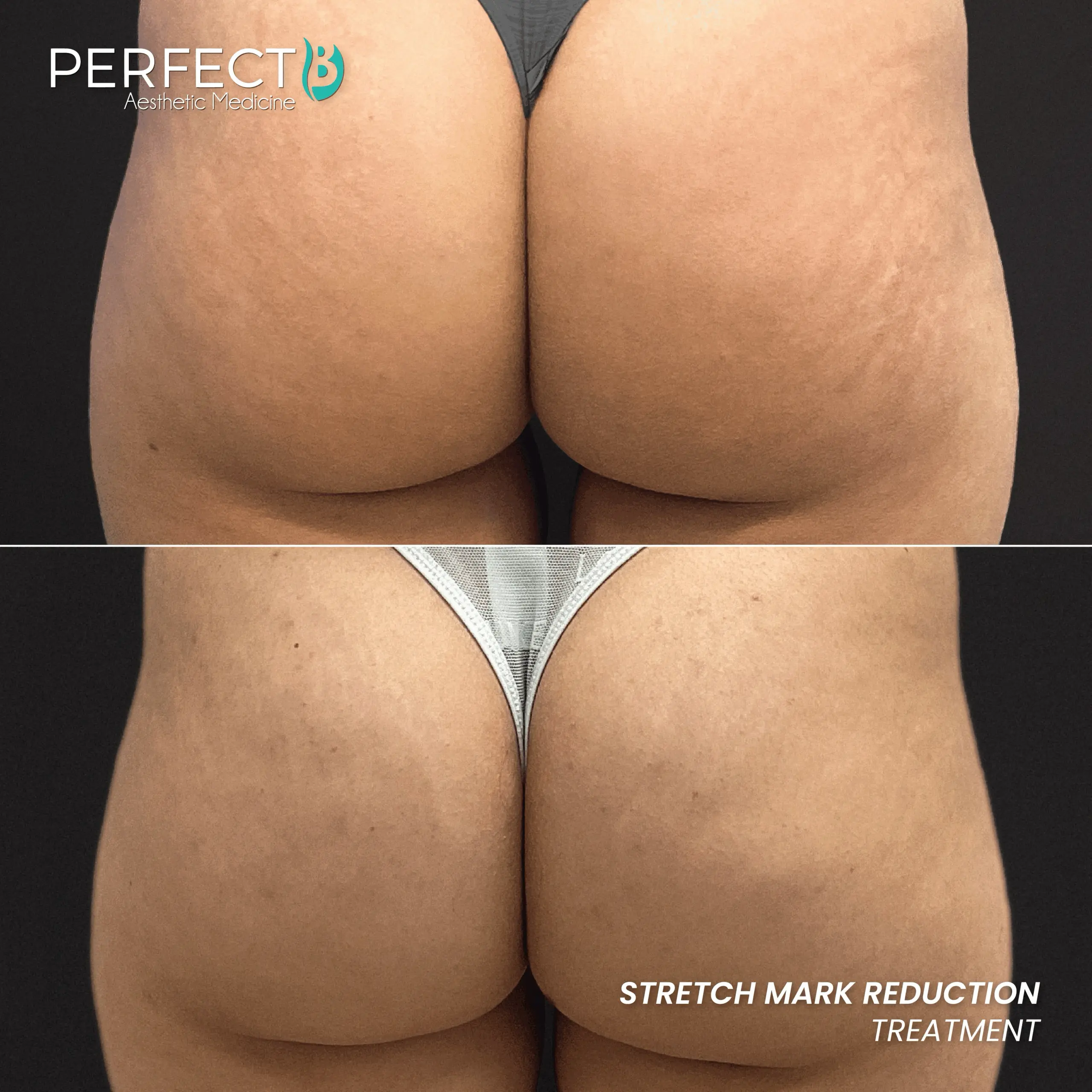Copy-of-Stretch-Mark-Reduction-Treatment-Perfect-B-Results-Image-Case-9405-PF-1080-x-1080-scaled