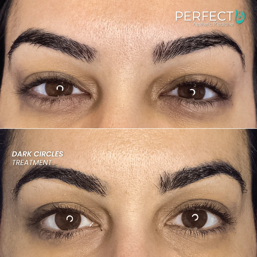 Dark Circles Treatment - Perfect B - Results Image - Case 5206 CM- 1080 x 1080