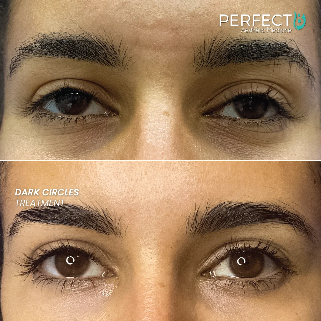 Dark Circles Treatment - Perfect B - Results Image - Case 5207 - 1080 x 1080