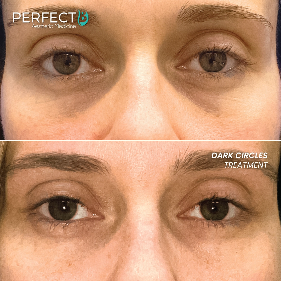 Dark-Circles-Treatment Perfect-B Results-Image Case-5208-DS 080-x-1080