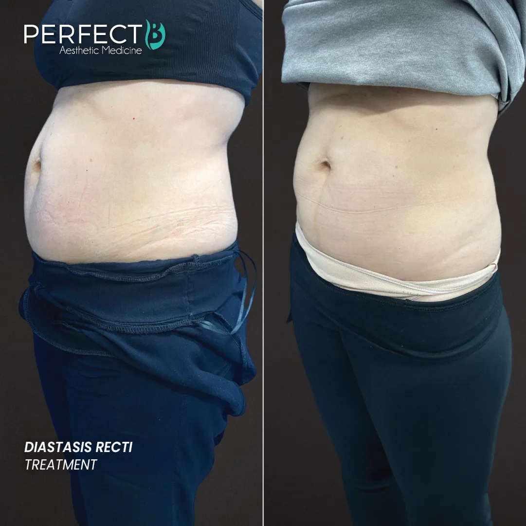 Diastasis Recti -Treatment-Perfect-B-Results-Image-Case-8212 -1080-x-1080