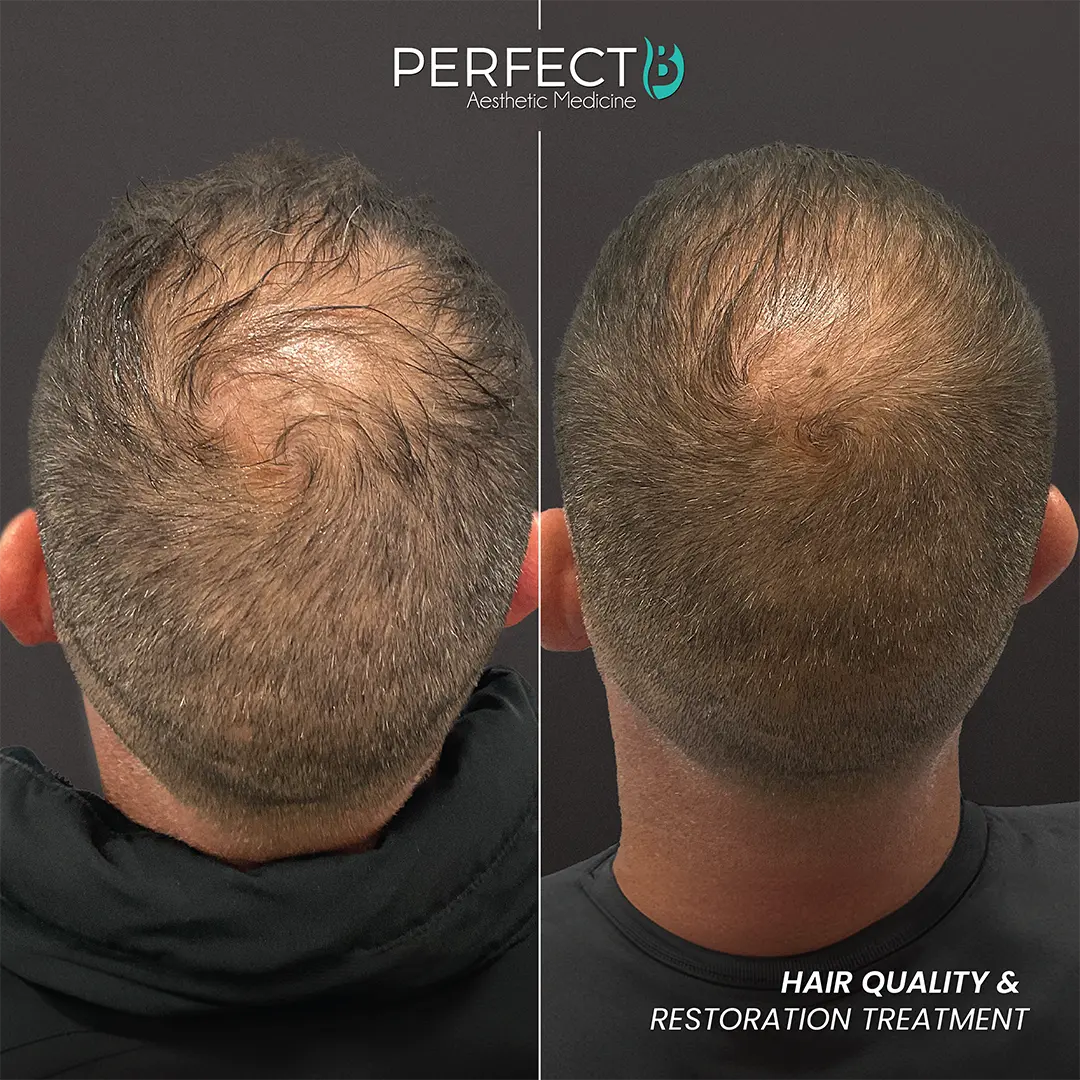 Hair Quality & Restoration Treatment - Perfect B - Results Image - Case 6402 YN - 1080 x 1080