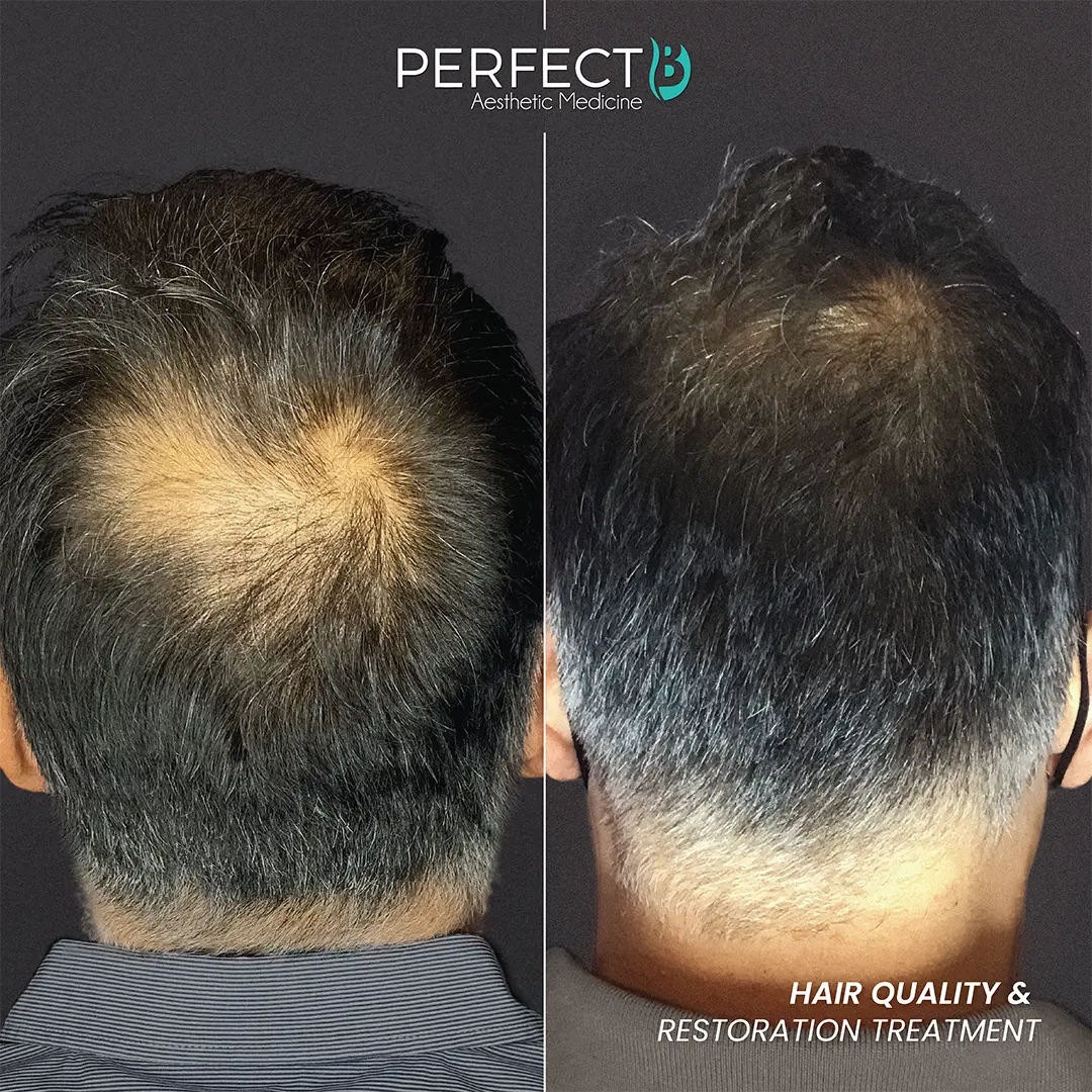Hair Quality & Restoration Treatment - Perfect B - Results Image - Case 6404 RS - 1080 x 1080