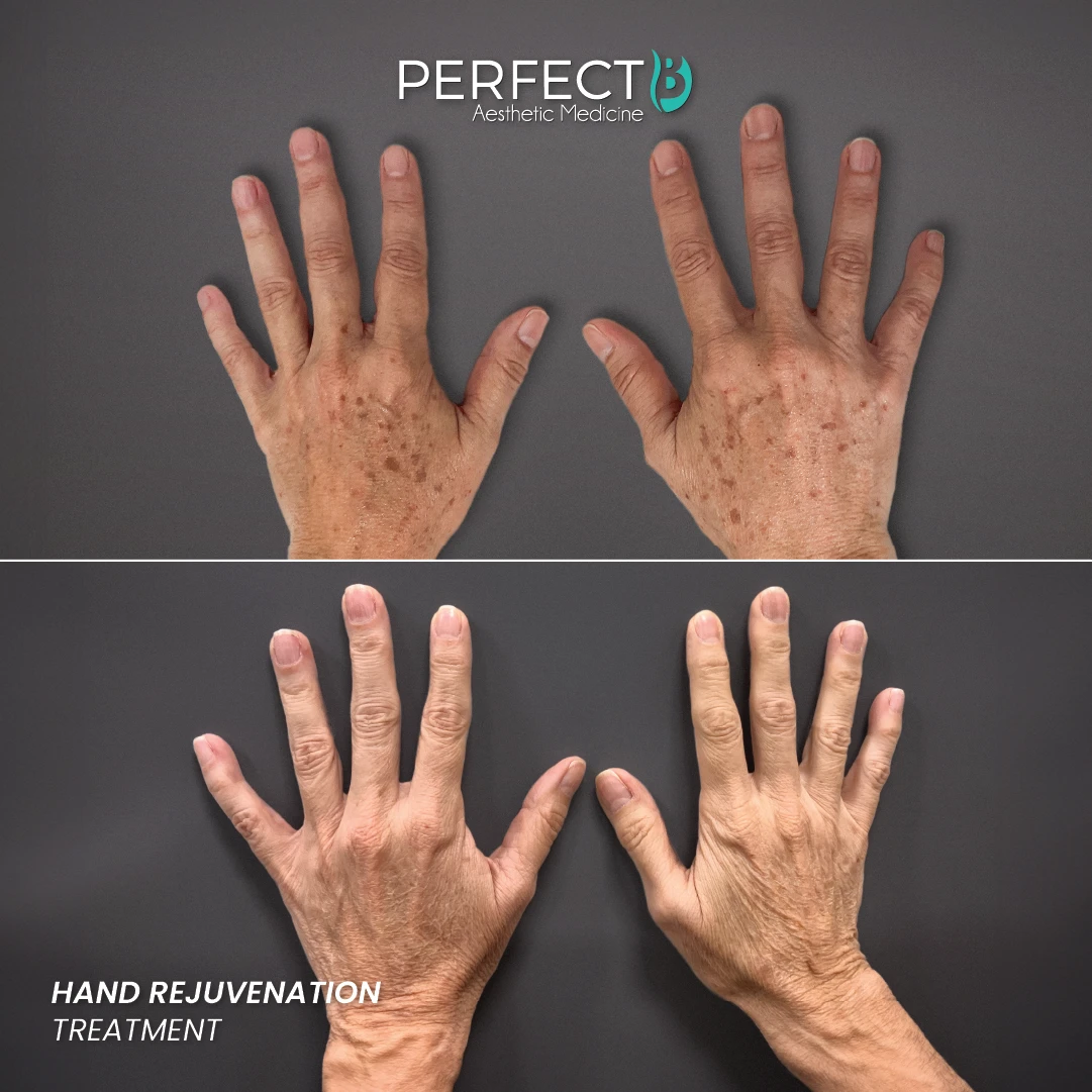 Hand Rejuvenation Treatment - Perfect B - Case 7001 - Results Picture - 1080 x 1080