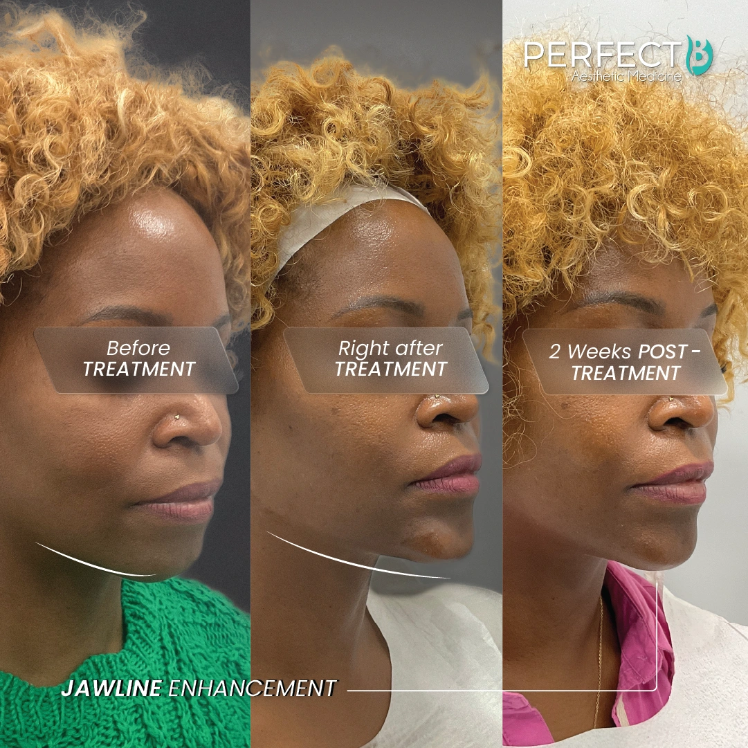 Jawline Enhancement Treatment - Perfect B - Case 5034 - Results Picture - 1080 x 1080