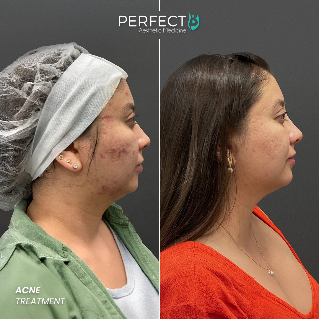 Perfect B - Results Image - [Acne Treatment] 4000 - 1080 x 1080