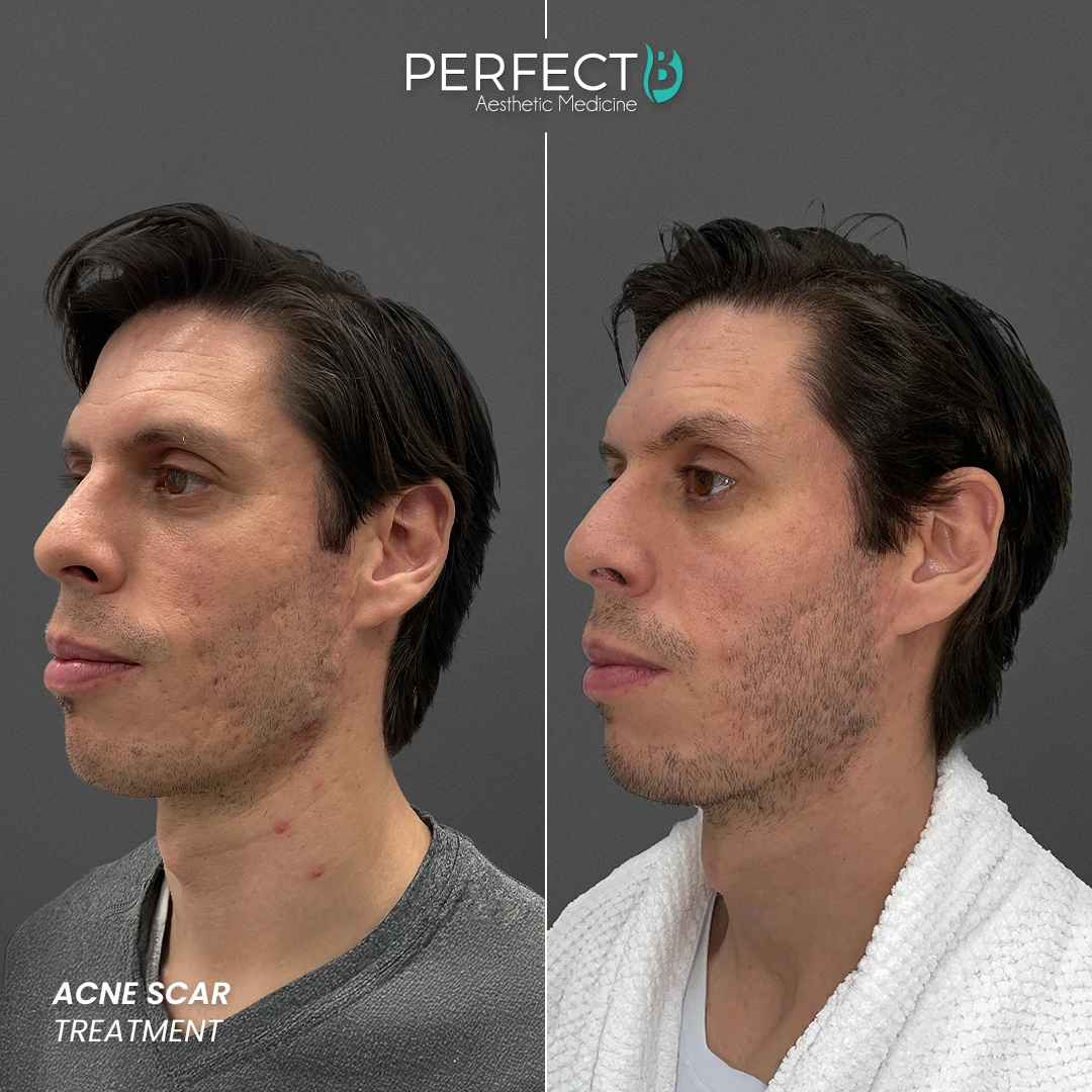 Perfect B - Results Image - [Acne Treatment] 4002 - 1080 x 1080
